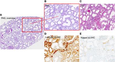 Extracorporeal light-chain elimination in myeloma with simple medium cutoff membrane hemodialysis: a retrospective cohort study